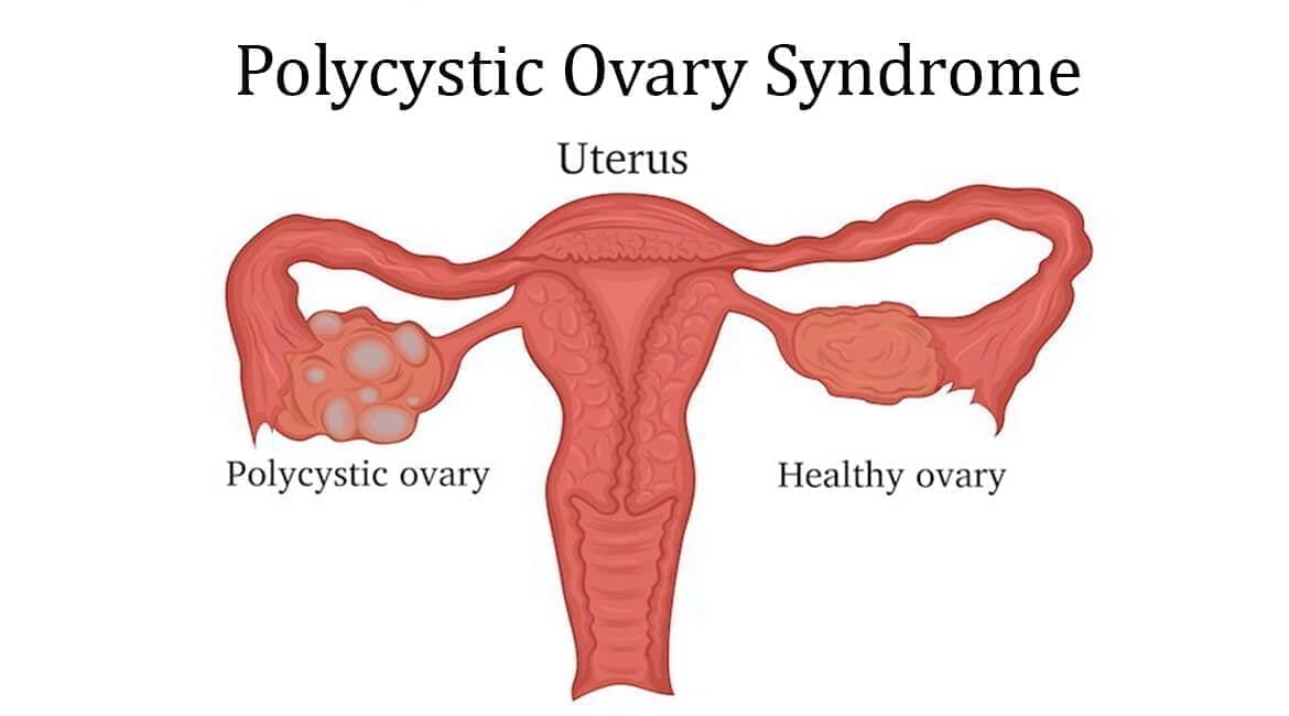 polycystic ovary syndrome