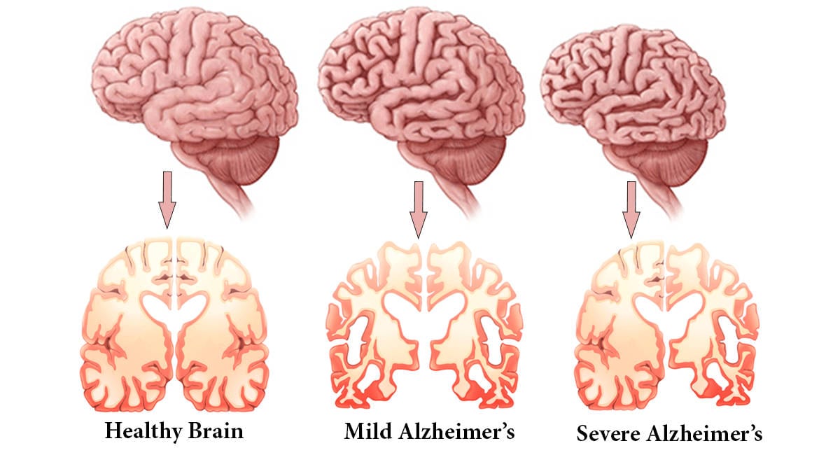 Alzheimers Disease