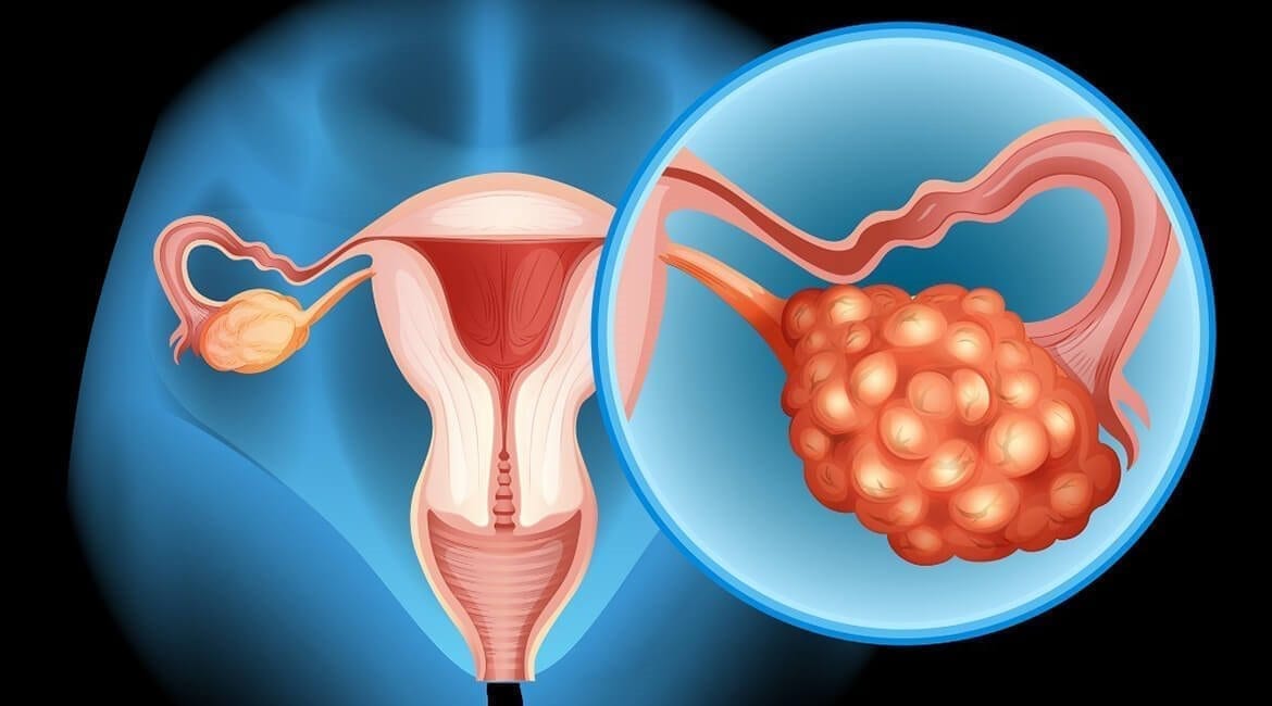 Ovarian Cancer