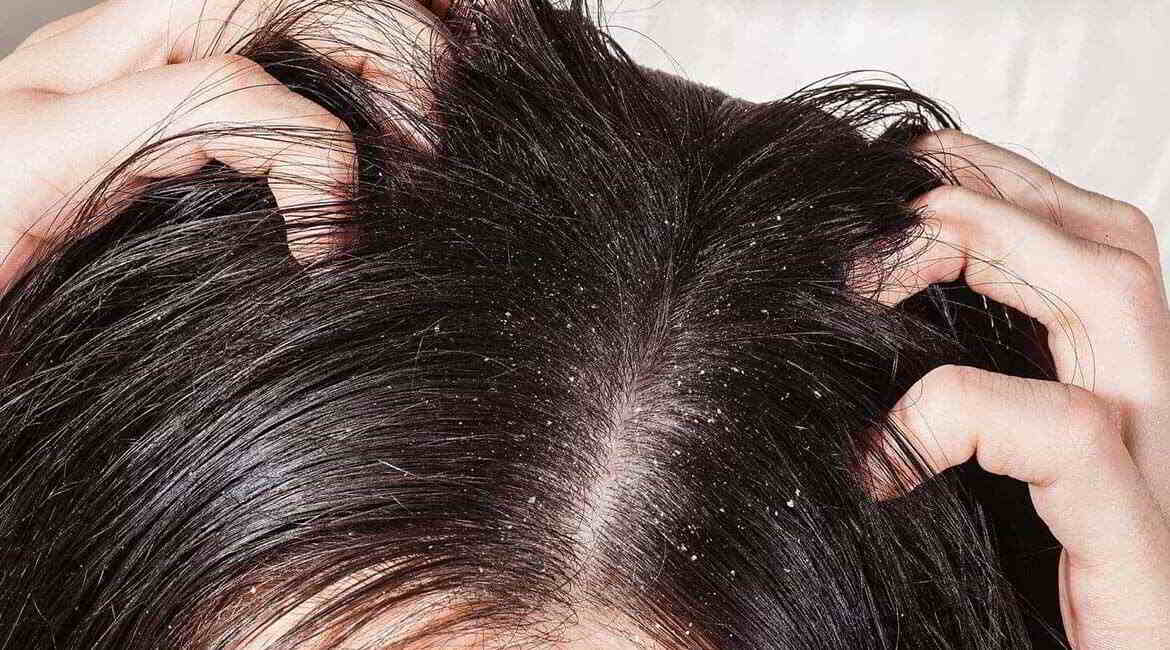 Dandruff Causes