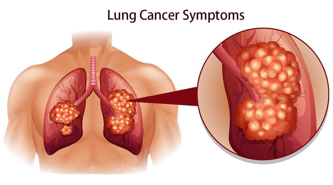 Lung Cancer