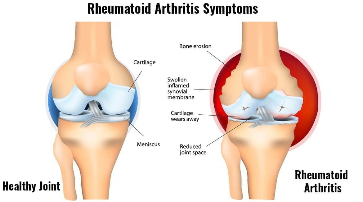 Rheumatoid Arthritis Symptoms