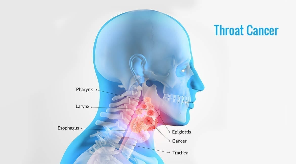 Throat Cancer