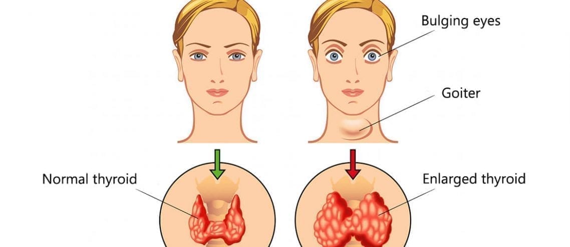 Hyperthyroidism