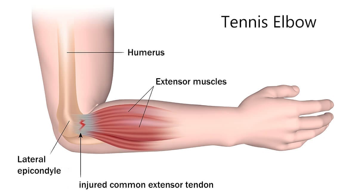 Tennis Elbow