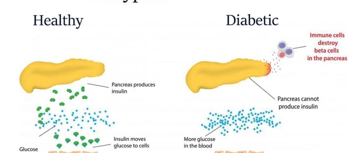 Type 1 Diabetes