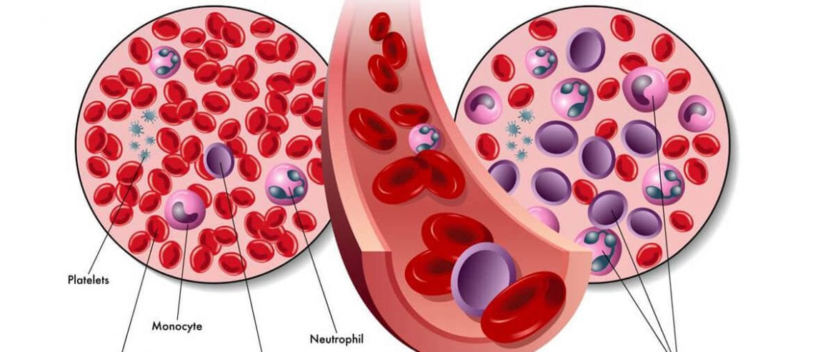 Blood cancer