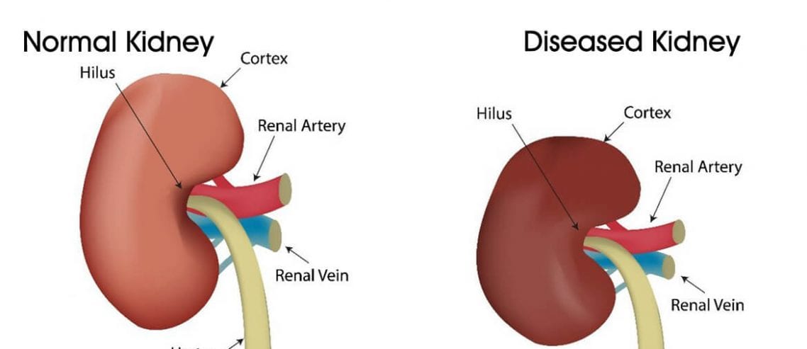 Kidney failure