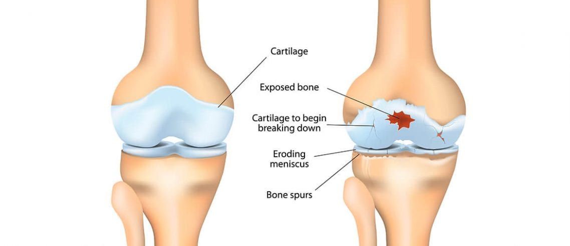 Osteoarthritis