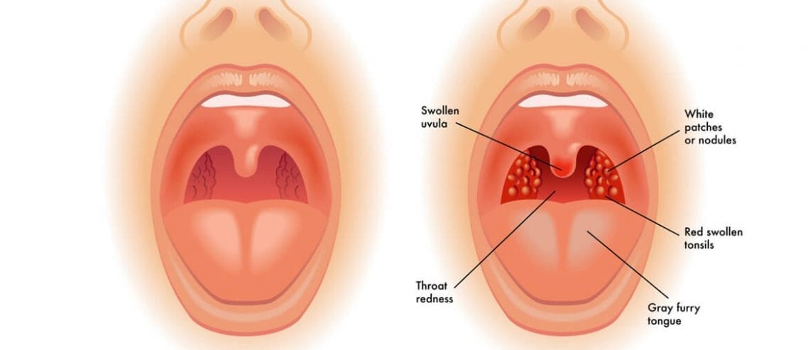 Tonsil Stones