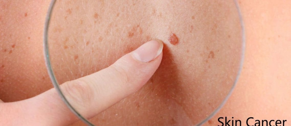 Types of skin cancer