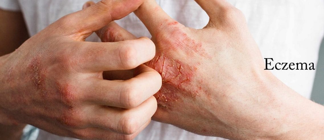 Home remedies for eczema