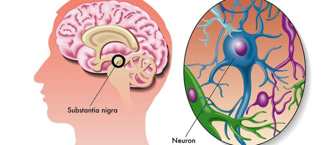 Parkinsons Disease