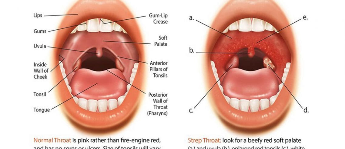 Strep Throat natural remedies