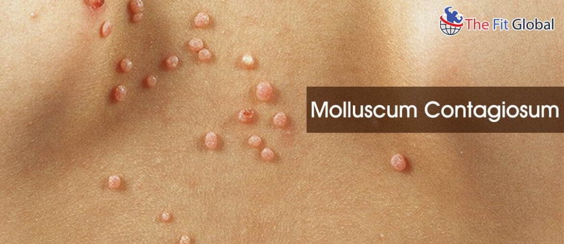 Molluscum contagiosum home remedy