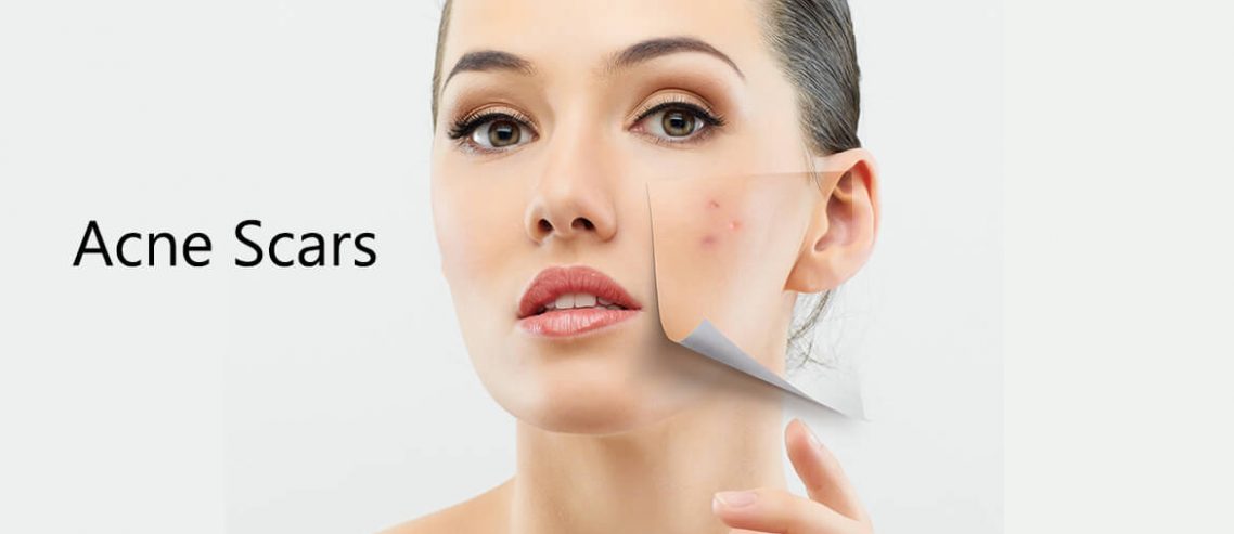 acne scars